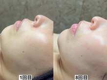 和歌山ララピール&韓国肌管理専門店/ララピール【艶肌/美白/くすみ】