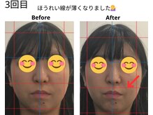 ベル/20代の方の小顔Before After