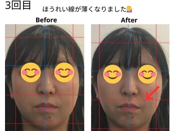 ベル/20代の方の小顔Before After