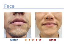 キングスサロン 熊本/メンズ髭脱毛ビフォーアフター