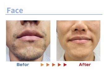 キングスサロン 熊本/メンズ髭脱毛ビフォーアフター