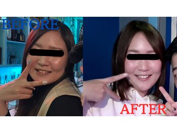 たかす整骨院/エラの張り/ほうれい線/小顔