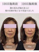 マハロ 海老名店(Mahalo)/小顔矯正　60代女性