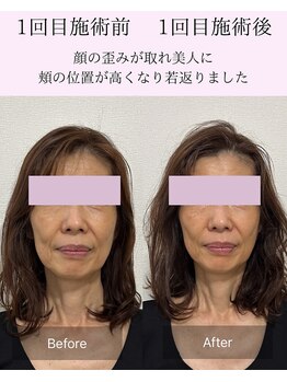 マハロ 海老名店(Mahalo)/小顔矯正　60代女性
