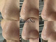 毛穴|小顔矯正|もみほぐし　CareNa Pom住吉店　毛穴洗浄専門サロン
