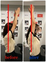 ナオル整体 新宿院(NAORU整体)/20代女性-巻肩矯正Before/After