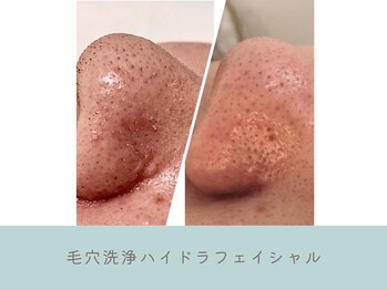 G/Hボディメイキング/毛穴洗浄ハイドラフェイシャル★