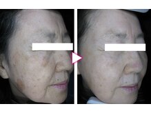 マイン イオンモール浜松市野店/ドクターリセラADS美肌活性