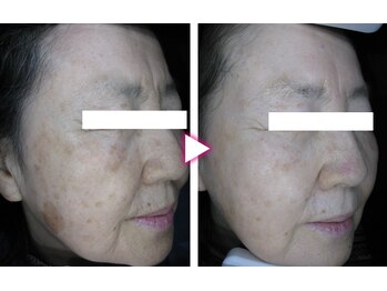 マイン イオンモール浜松市野店/ドクターリセラADS美肌活性