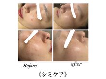 サロンドシェリ(salon de cheri)/シミケア