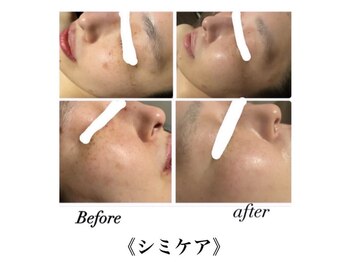 サロンドシェリ(salon de cheri)/シミケア