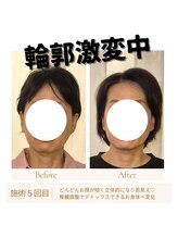 ミラクル(Miracle)/輪郭激変中です