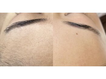 ソアン(Soin)/顔脱毛