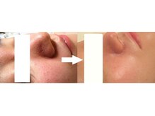 サロンドエステケイワイ(de KY)/フェイシャル☆毛穴・ニキビ改善