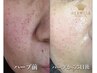 ダウンタイムなし！　【肌質改善/美肌育成】マグマハーブピーリング60分