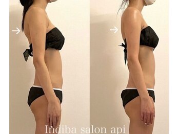 アピ(api)/症例写真【インディバ】