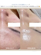 クレヴィー(Creviy)/韓国式3D毛穴洗浄×ハーブ