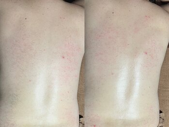 クラウン ジュエルズ(CROWN JEWELS)/男性の背中Wax