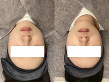 キレイ美肌 北心斎橋店/韓国×マイクロウェーブリフト