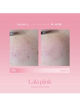 グラッソ(GRASSO)/ララピンク