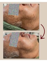 リーシャ(Reesha)/プラズマトリートメント