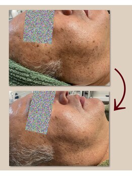 リーシャ(Reesha)/プラズマトリートメント