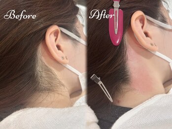 ピミル(PIMIL)/うなじ脱毛