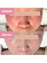 リシェル(Richelle)/ 【GREENPEELセンシダーム】