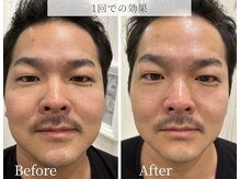 ブリリオ 池袋店(Brillio)/1回での効果/リフィット小顔施術