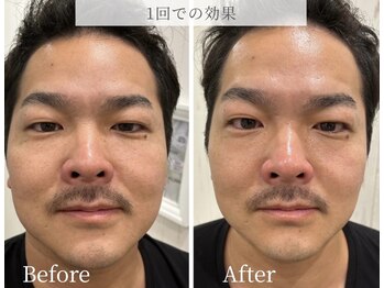 ブリリオ 池袋店(Brillio)/1回での効果/リフィット小顔施術