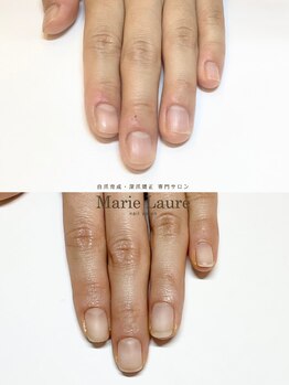 マリーロール 梅田店(Marie Laure)/自爪育成/深爪矯正/ネイルケア