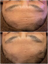 桜/最新光エステ