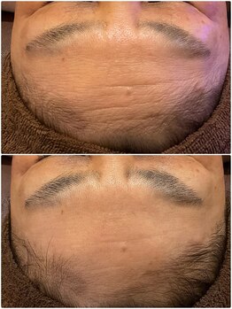 桜/最新光エステ