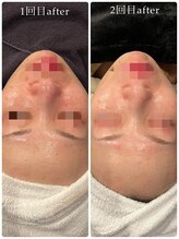 ビースキン(B SKIN)/フェイシャルエステ