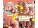 巻き爪も改善!