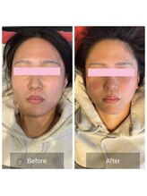 プライミー(PRIMY)/フェイスライン激変！