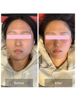 プライミー(PRIMY)/フェイスライン激変!