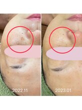 シシラ(shishira)/シミケアでお悩み改善！