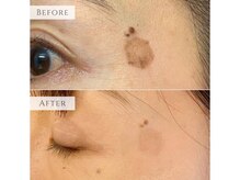 ラシェプリズ(LACHER PRISE)/シミ改善プログラム