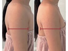 ローズドゥシャロン(Rose de CHALON)/脂肪分解美容液レッドショット