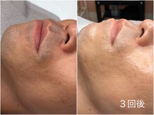 アロマ(AROMA)の雰囲気(ニキビケア、毛穴専門◎越谷/せんげん台/大宮/春日部/草加/)