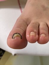 フットメンテ 巻き爪矯正センター 南浦和/巻き爪矯正　正面初回施術