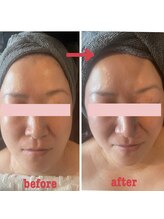 ダリア(Dahlia)/ハーブピーリング