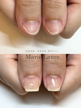 マリーロール 梅田店(Marie Laure)/深爪矯正/自爪育成/自爪風
