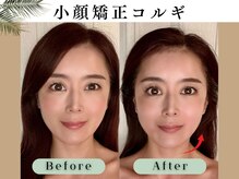 スイスパ 恵比寿(翠SUI SPA)/【小顔矯正コルギ】Before/After