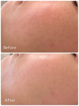 ククル(KUKULU)/陶肌ピール3回目♪（30代女性）