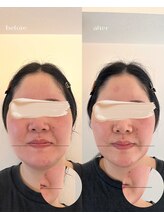 サンク(cinq)/切らない脂肪○引インモード一回