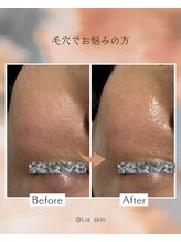 リアスキン(Lia skin)/頬の毛穴でお悩みの方