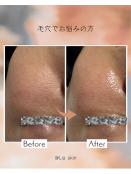 リアスキン(Lia skin)/頬の毛穴でお悩みの方