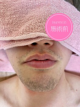 ローランサン(laurencin)/【Before1】